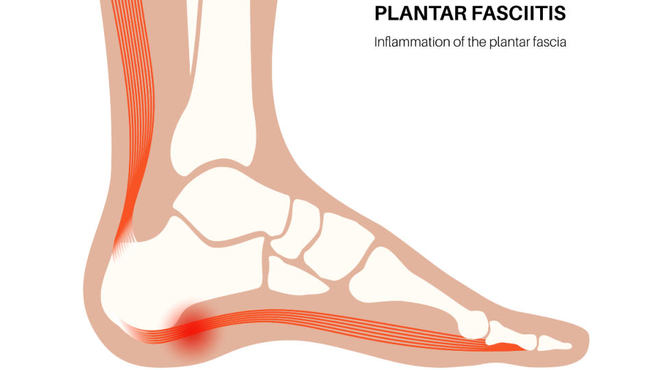 An illustration of plantar fasciitis, which can cause pain so bad you can't walk