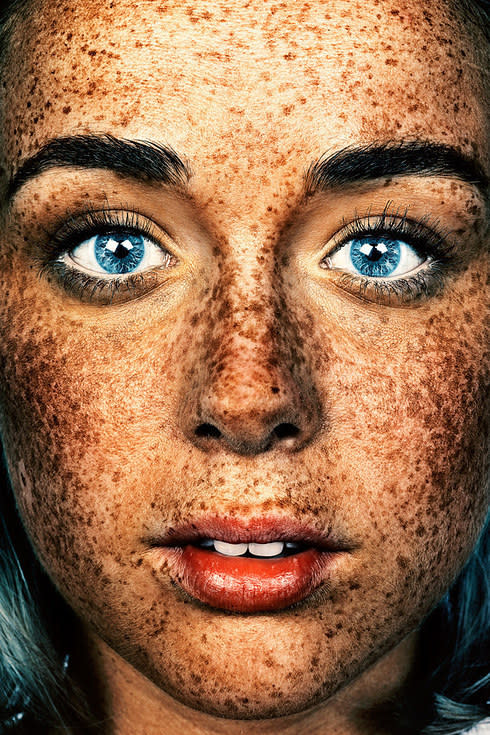 freckles on face