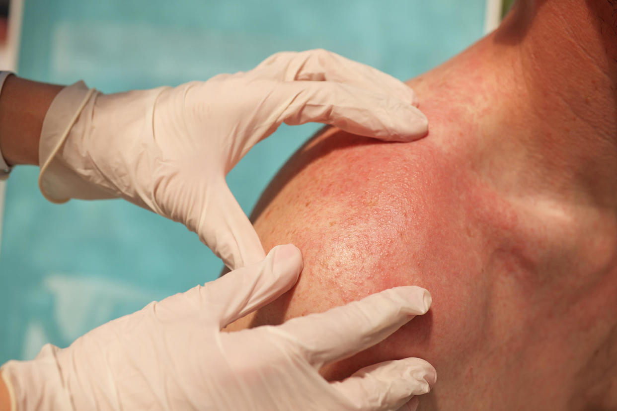 Doctor dermatologist examining rash on skin of man shoulders. (Ivan-balvan / Getty Images)