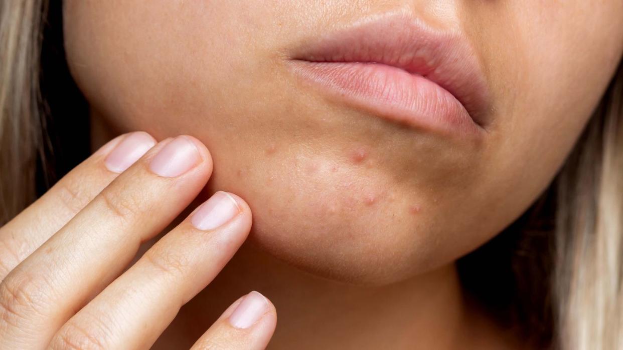 cropped shot of a young woman's face with the problem of acne pimples on the chin allergies, dermatitis, rash problem skin, care and beauty concept dermatology, cosmetology