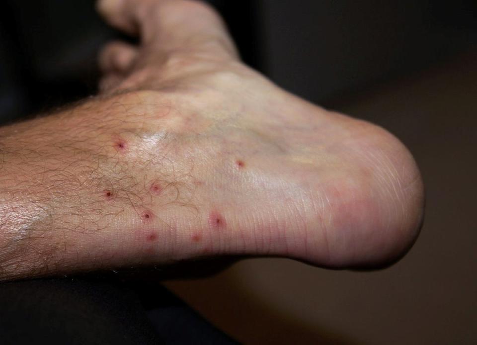 Back of person's ankle with red chigger bites