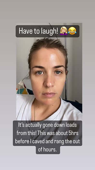 gemma-atkinson-face-swollen