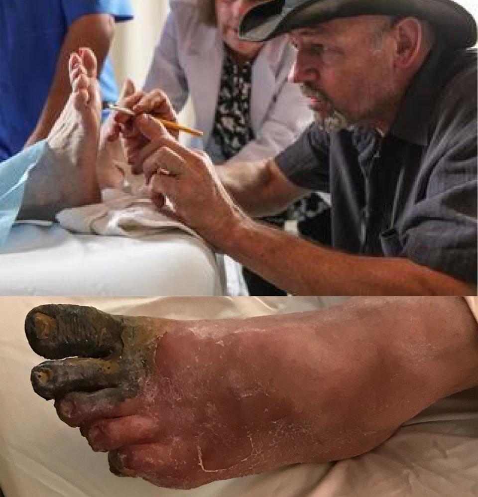 Roy Wooley works on a diabetic foot effect with a removable gangrene toe for "The Resident."