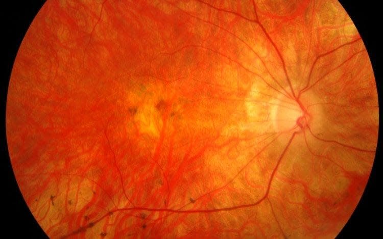 Charities warned that a growing national crisis was leaving patients in danger of visual impairment