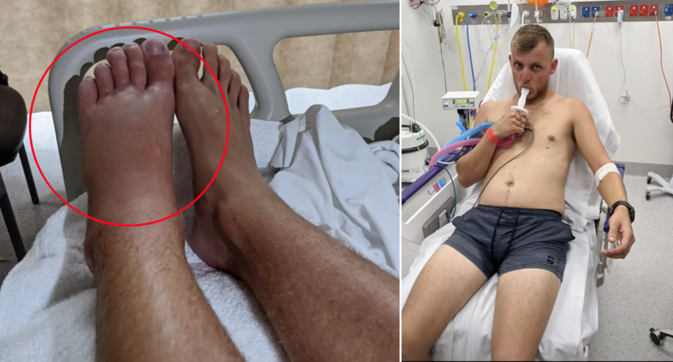 Left: The man's swollen foot after stepping on a stone fish. Right: Brock Harris in hospital after the stonefish injury.. Source: TikTok