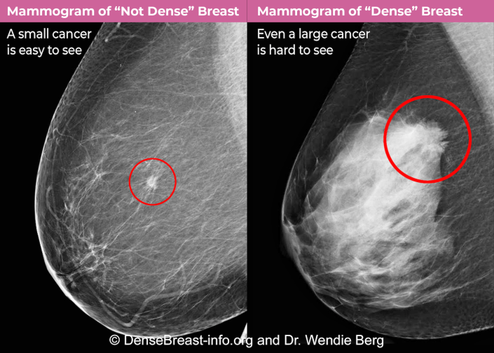 Mamas densas não apenas tornam o câncer mais difícil de detectar, mas também aumentam o risco de câncer.  DenseBreast-info.org e Dr.  Wendie Berg