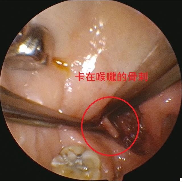 一名婦人自述右邊喉嚨痛已經有超過半年的時間，沒想到，竟是喉嚨長骨刺，必須要開刀把骨刺取出來！（圖／陳亮宇醫師授權使用）