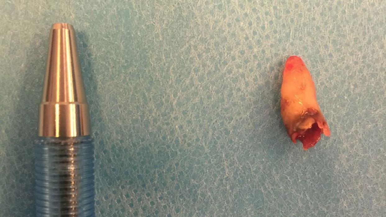 The tooth extracted by doctors in Denmark from inside the man's nostril. Pic: BMJ Case Reports