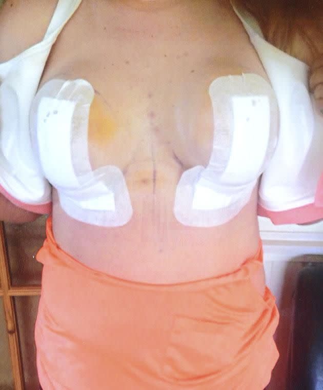 Kirsty realised something was wrong when nurses undid her bandages at her post-op check up. Photo: Mega