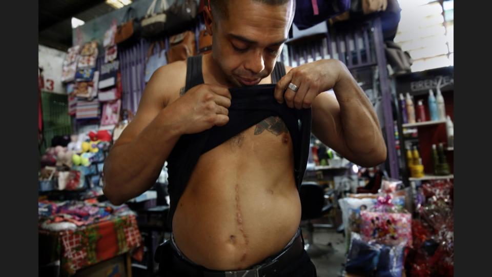 A man in El Salvador shows his gunshot wounds.