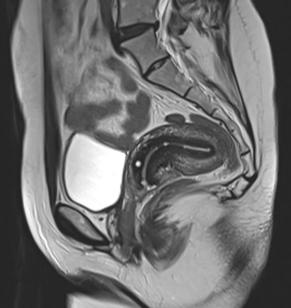 MRI scan of the lumbar spine showing the vertebrae, spinal cord, and intervertebral discs