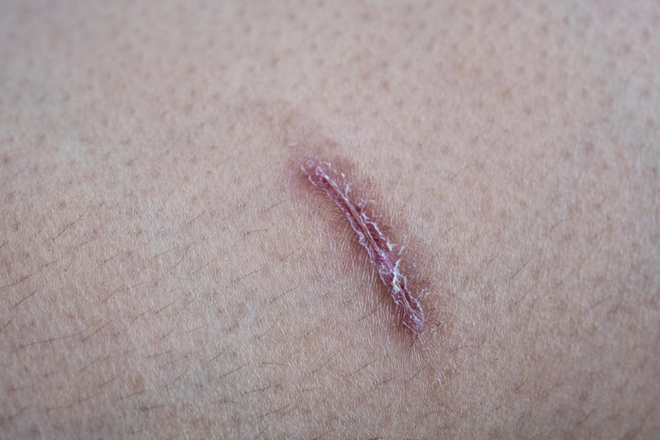 Las costras están compuestas de sangre y tejidos muertos. Que se caigan es parte normal de la cicatrización pues la piel sigue su proceso de regeneración. (Getty Creative)