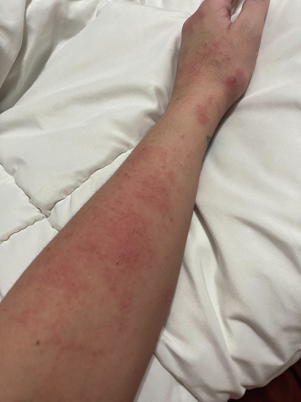 Hives on her arm are a "typical daily reaction" from alpha-gal syndrome, Jaclynn Scott said.