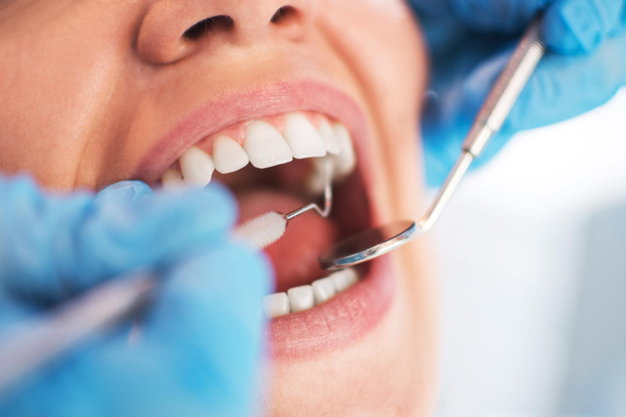 Aunque la gingivitis podría ser la causa más común de las encías inflamadas, hay otras razones por las cuales puedes estar sufriendo la dolorosa inflamación en la boca. (Getty Creative)