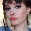 <p>Les réseaux sociaux encouragent de plus en plus à avoir confiance en soi, peu importe ses différences. Récemment sur Instagram, les hashtags #SkinPositivity et #acneisnormal ont fait leur apparition. Crédit photo : Instagram pigss </p>