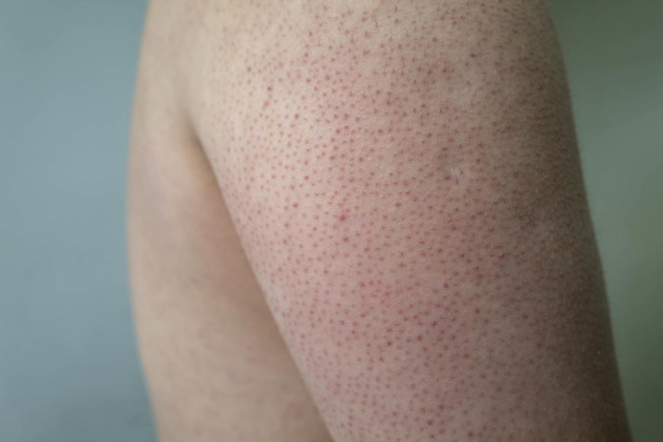 Keratosis pilaris (Getty Images)