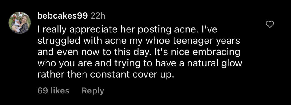 "I really appreciate her posting acne; I've struggled with acne my whole teenager years and even now to this day; it's nice embracing who you are and trying to have a natural glow rather [than] constant cover up"