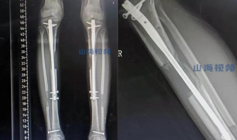 一名19歲少女認為自己太矮，竟做了「斷骨增高」手術，術後卻因反覆感染以致無法行走。（翻攝自《山海視頻》）