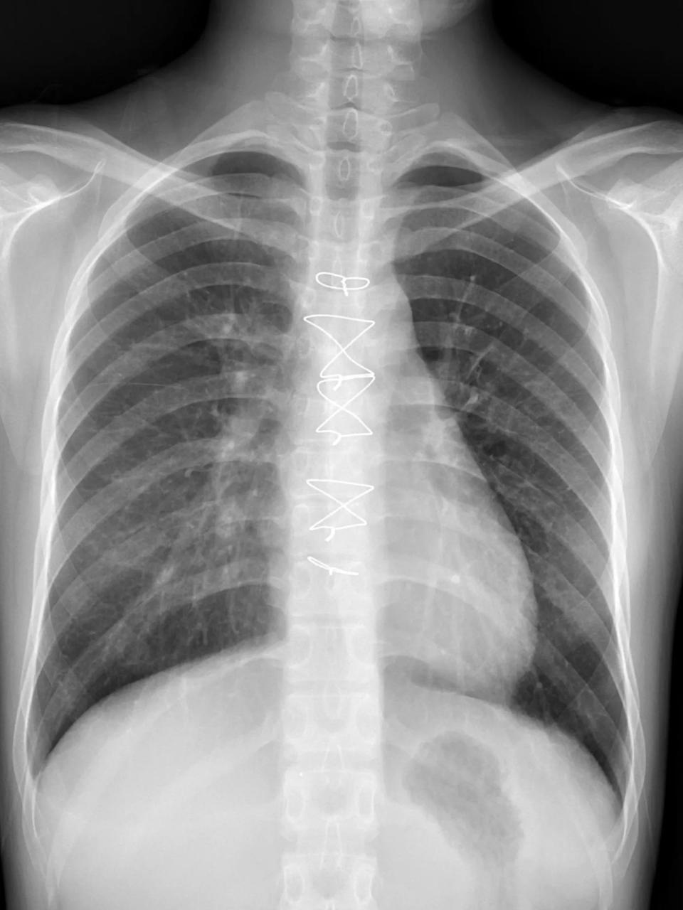 <strong>鄭小姐出院後第二次回診檢查，胸部X光影像顯示肺部與心臟已恢復正常。（圖／花蓮慈濟醫院提供）</strong>