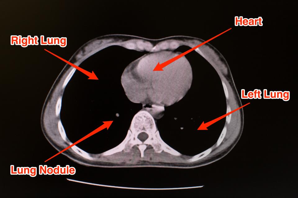 Normal Lung CT Scan