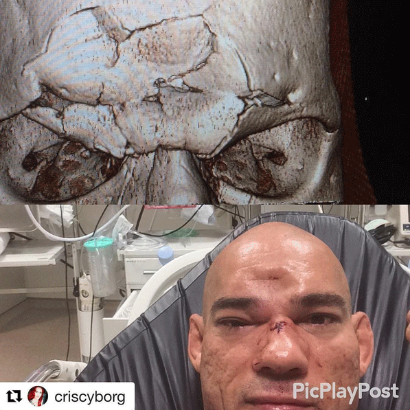 Evangelista 'Cyborg' Santos fractured his skull at Bellator 158. (Credit: Instagram)