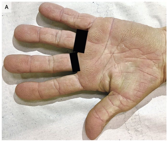 Aspecto que tenían las palmas de la mano de la paciente brasileña. (Crédito imagen: <i>New England Journal of Medicine</i>).