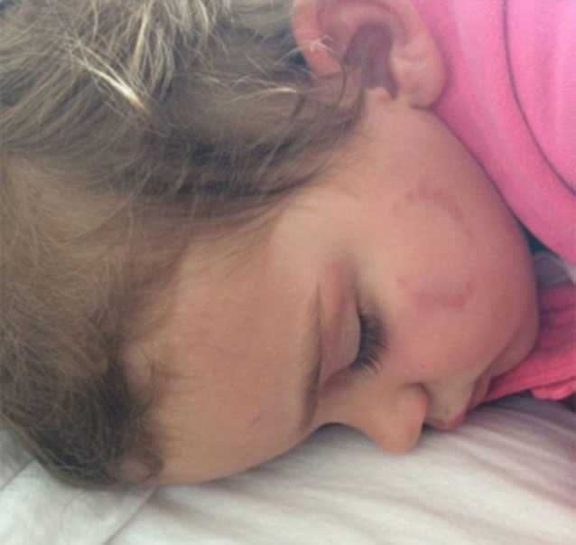 A doctor confirmed two-year-old Eva's injuries after she was allegedly attacked by another child. Photo supplied and used with permission from mother Kristel Ness.