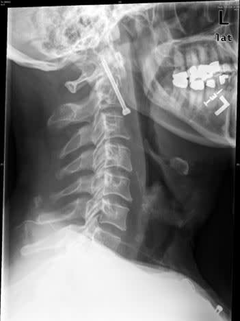 This X-ray released by New York's Montefiore Medical Center, Monday, July 16, 2007, shows a screw that was inserted in the broken neck of Paul Robinson, of Kirkland, Wash. Robinson, 53, was in the steep upper deck of Yankee Stadium with his wife and son July 8, 2007, when an unidentified man above him fell down several rows of seats, breaking Robinson's vertebra. (AP Photo/Montefiore Medical Center)