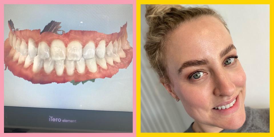 Photo credit: Invisalign scan/ Cassie Powney