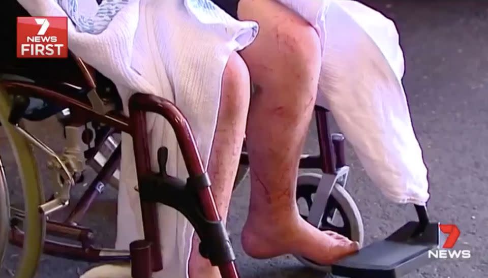 Cuts and scratches on Dylan's legs after 10 days in the bush. Source: 7 News