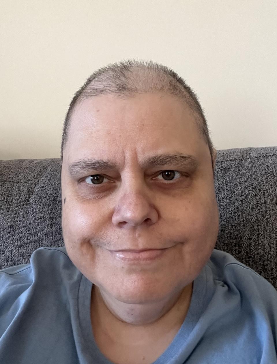 Ann lost her hair after her chemotherapy treatments (Collect/PA Real Life)