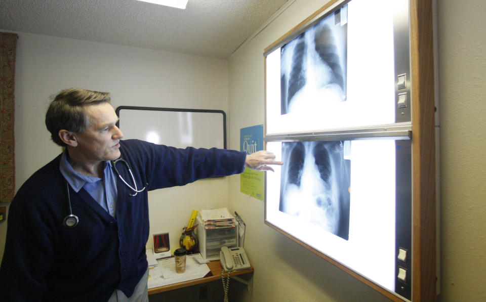 FILE - Dr. Brad Black with the Center for Asbestos Related Disease health clinic is shown looking at X-rays, Feb. 18, 2010, in Libby, Mont. Attorneys for the clinic denied allegations that it submitted false medical claims, earning Libby residents lifetime government medical benefits. (AP Photo/Rick Bowmer, File)