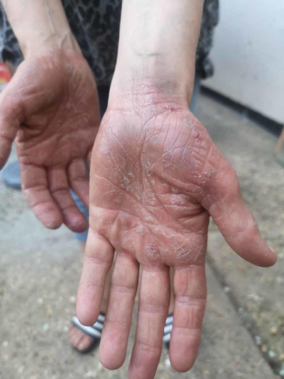 Maria’s hands became itchy and sore during the first lockdown in March 2020. (Collect/PA Real Life)