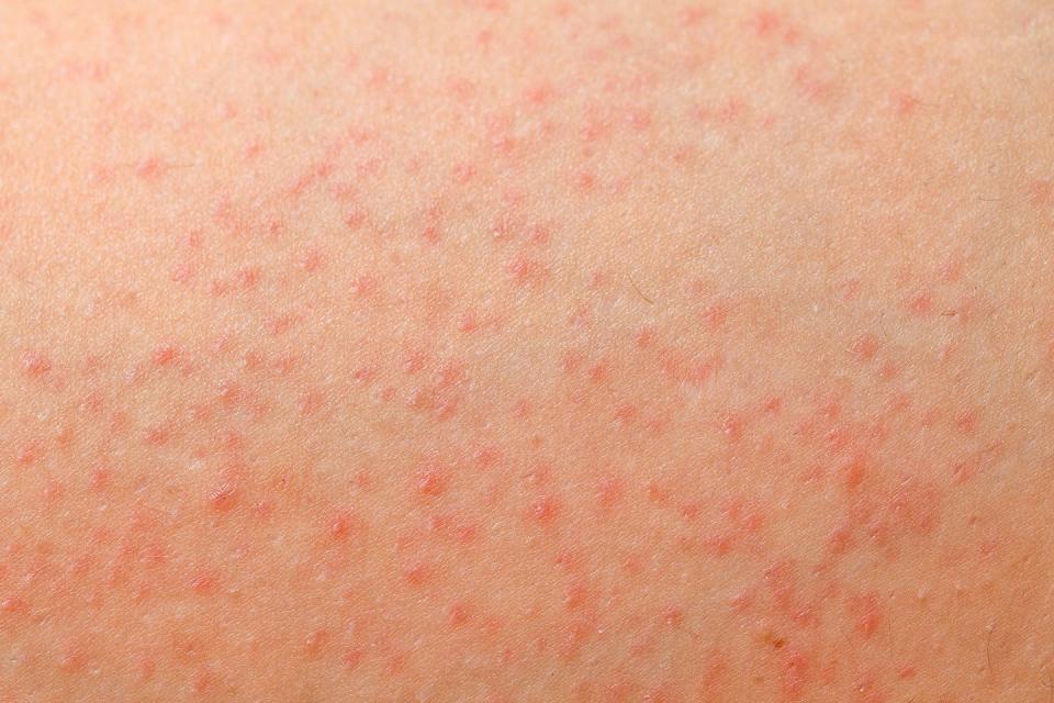 folliculitis