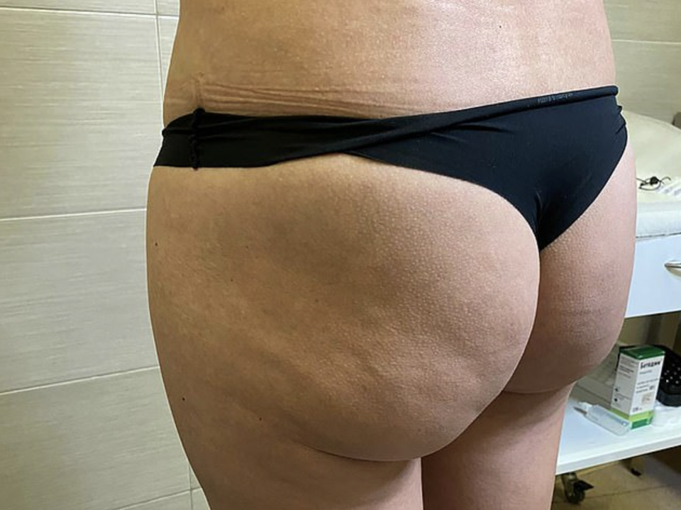 lyuboc plastic surgery fail bum after