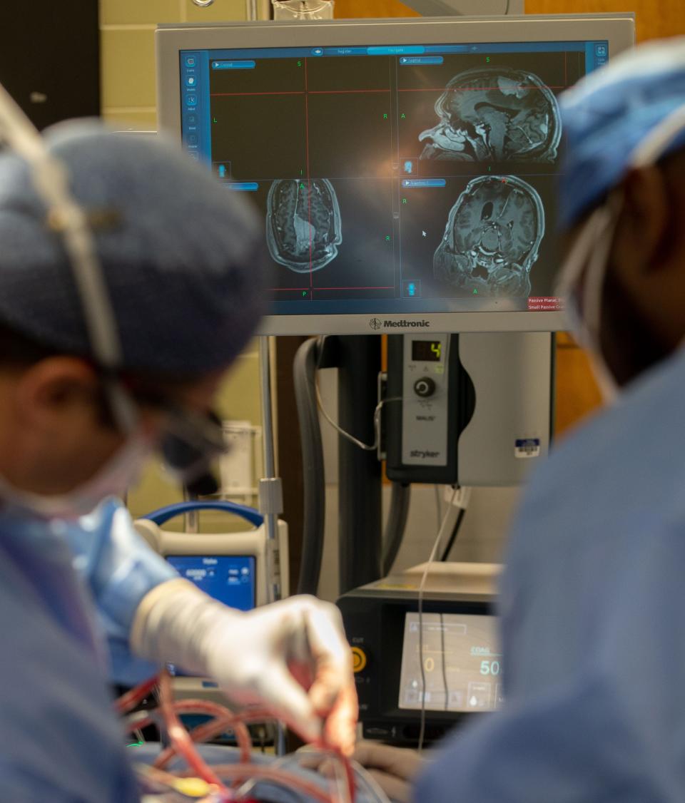 Dr. Andy Boucher, a neurosurgeon with Semmes Murphey Clinic, left, and Kendrick Whitehead, certified surgical first assistant at Saint Francis Hospital-Memphis, right, perform a craniotomy in preparation for the placement of a GammaTile on Wednesday, Aug. 3, 2022, at Saint Francis Hospital-Memphis. Surgeons first remove the brain tumors and then fill the remaining space with the GammaTile — a device that delivers targeted radiation therapy.