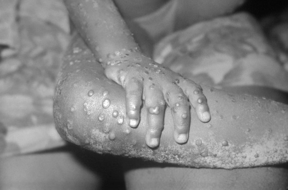 BONDUA, LIBERIA - UNDATED: In this 1971 Center For Disease Control handout photo, monkeypox-like lesions are shown on the arm and leg of a female child in Bondua, Liberia. The Centers for Disease Control and Prevention said June 7 the viral disease monkeypox, thought to be spread by prairie dogs, has been detected in the Americas for the first time with about 20 cases reported in Wisconsin, Illinois, and Indiana.  (Photo Courtesy of the CDC/Getty Images) 