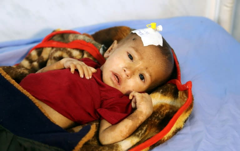 A malnourished Yemeni child receives treatment at a hospital in the Yemeni port city of Hodeidah on January 16, 2018