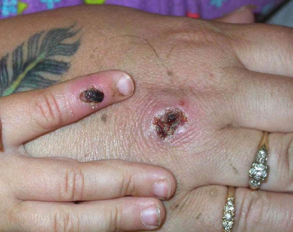 Sores are seen on the hands of an adult and a child.