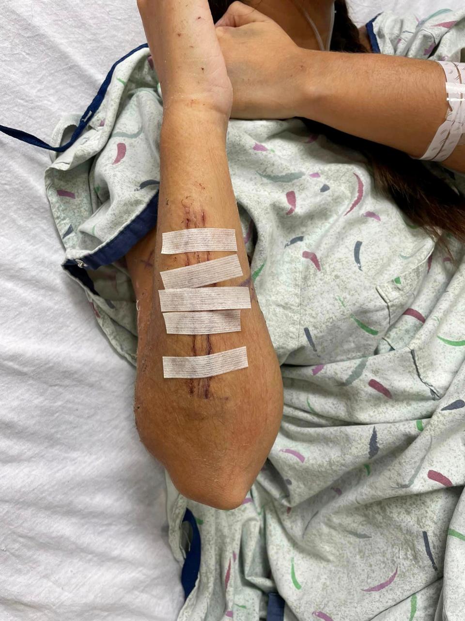 Mia Virag, 23, of Spring Lake, was hospitalized for 38 days with life-threatening injuries after getting hit by a speeding dirt bike rider as she headed to her new job as a foster care specialist. To date, she has had 12 surgeries, including to her liver, spleen, kidneys, lungs and right arm.