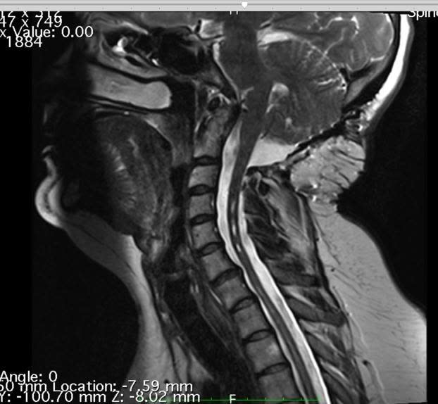 An X-ray of Ms Maltby’s neck, showing her vertebrae slipping out of place. Source: Supplied/ Kirstin Maltby