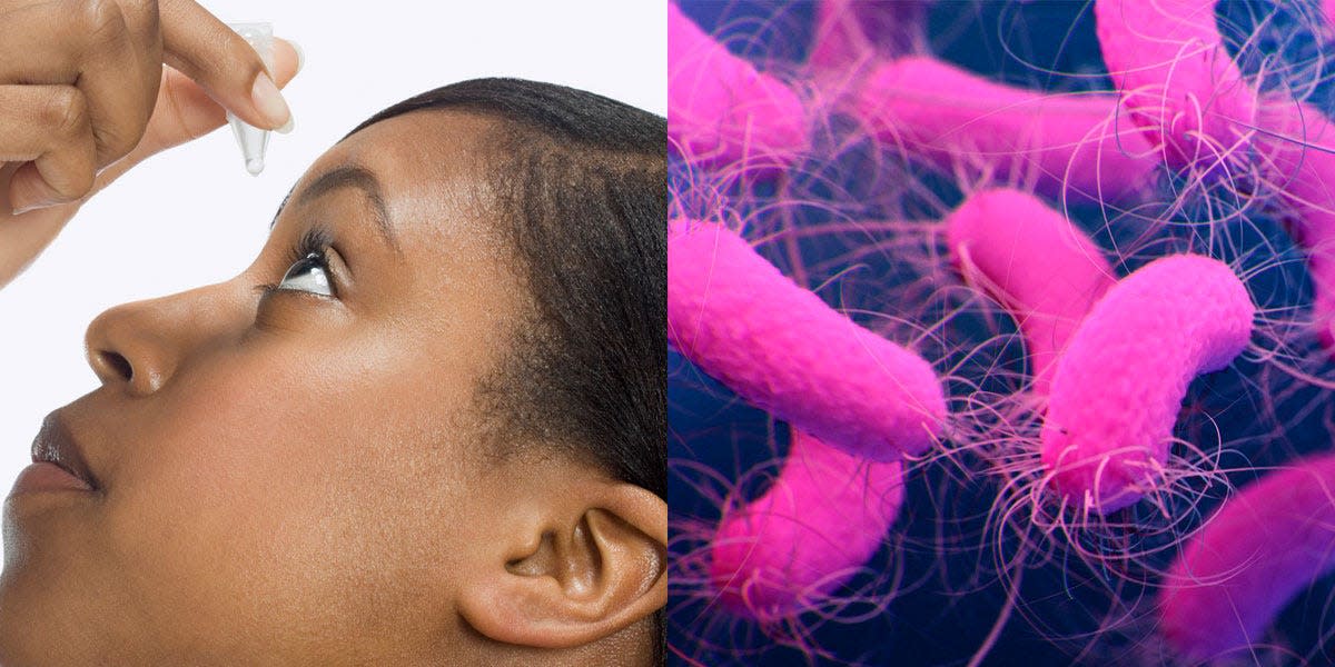woman putting eye drops in side by side with microscopic photo of drug resistant bacteria