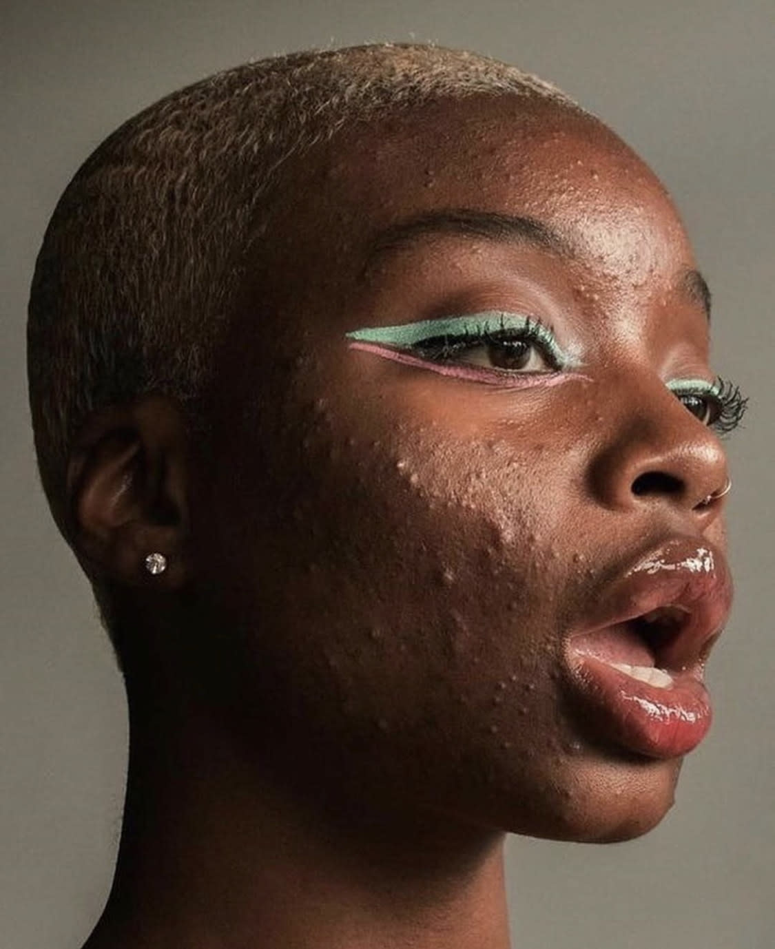 Nazhaya Barcelona went viral after sharing her acne journey online. (Photo courtesy of Nazhaya Barcelona)