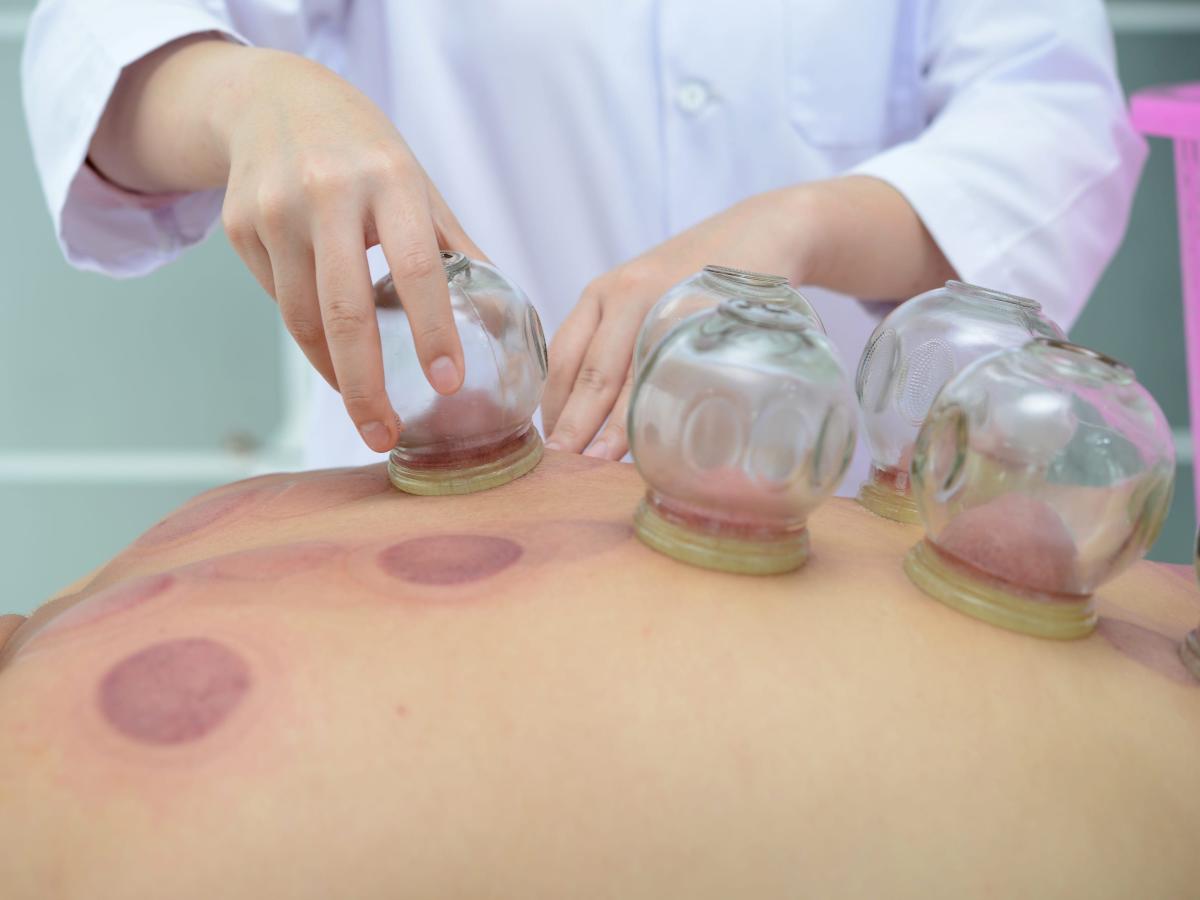 Clinical Dry Cupping - Cupping Hamstring Stretch 