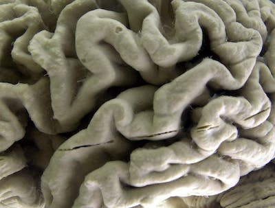 Una sección de un cerebro humano con la enfermedad de Alzheimer expuesta en el Museo de Neuroanatomía de la Universidad de Búfalo, en Búfalo, N.Y. (AP Photo/David Duprey)