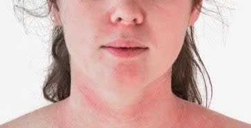 A woman is seen with a red rash on her face and neck