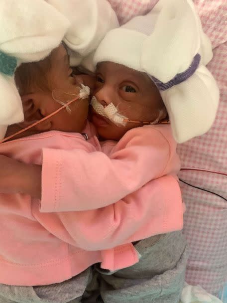 PHOTO: Amanda Arciniega and James Finley's conjoined twin daughters, Amy and Jamie, underwent separation surgery at Cook Children's Medical Center in Fort Worth, Texas. (Courtesy of Cook Children's Medical Center)