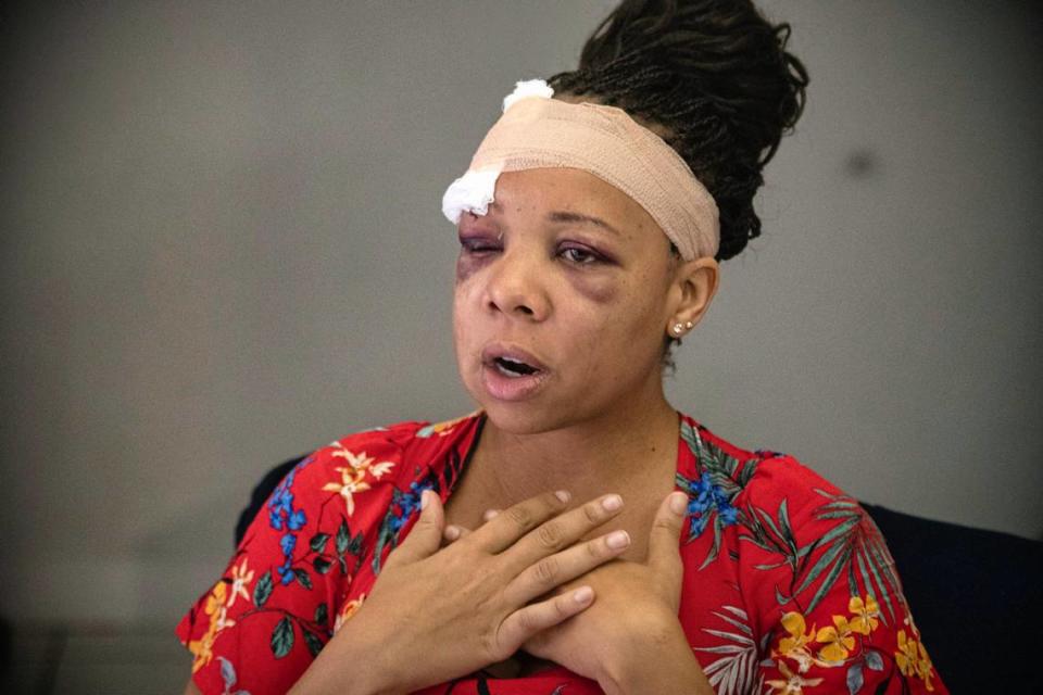 On June 2, 2020, LaToya Ratlieff talks about being shot in the face with a foam projectile at a protest in Fort Lauderdale. Ratlieff was choking from tear gas and trying to leave the area when she was shot that Sunday.