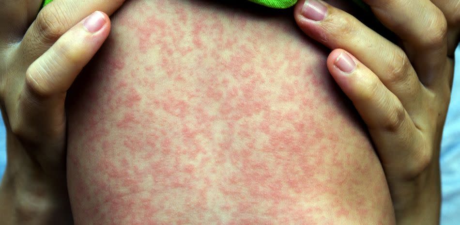 Measles is easily preventable (Picture Getty)