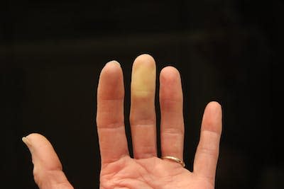 Although Raynaud’s phenomenon typically affects fingers and toes, it can also affect the nose, ears and lips. <a href="https://www.gettyimages.com/detail/photo/adult-hand-and-fingers-raynauds-phenomenon-royalty-free-image/1387926245?phrase=Raynauds%27s%20phenomenon&adppopup=true" rel="nofollow noopener" target="_blank" data-ylk="slk:Barb Elkin/iStock via Getty Images Plus;elm:context_link;itc:0;sec:content-canvas" class="link ">Barb Elkin/iStock via Getty Images Plus</a>